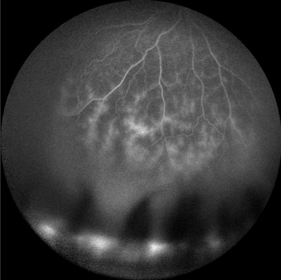 example of retinal vaculitis
