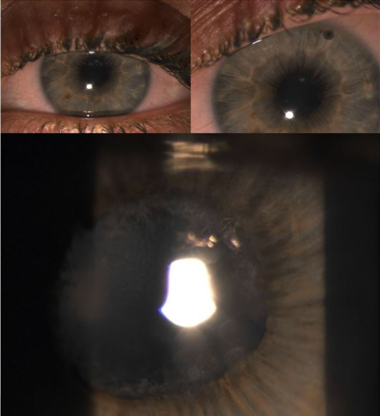 Juvenile Idiopathic Arthritis and Associated Uveitis MERSI